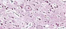 Mózg osoby cierpiącej na chorobę Alzheimera