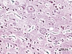 Mózg osoby cierpiącej na chorobę Alzheimera