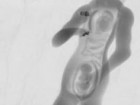 F.R. Schwartz/Duke University/RSNA