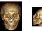Saleem SN and Hawass Z (2021), Front. Med. 8:778498. doi: 10.3389/fmed.2021.778498